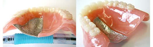 レジン製義歯とチタン製義歯