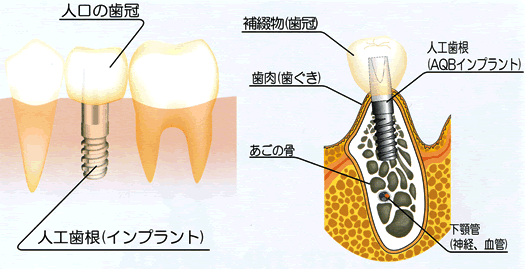 implant̎dg